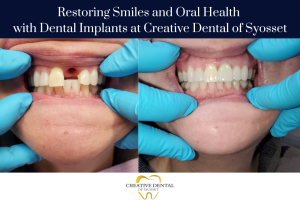 Restoring Smiles and Oral Health with Dental Implants at Creative Dental of Syosset