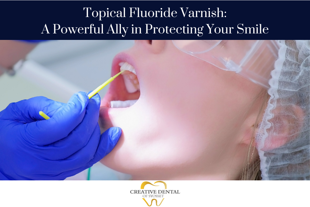 Topical Fluoride Varnish in Syosset, NY: Adults & Kids