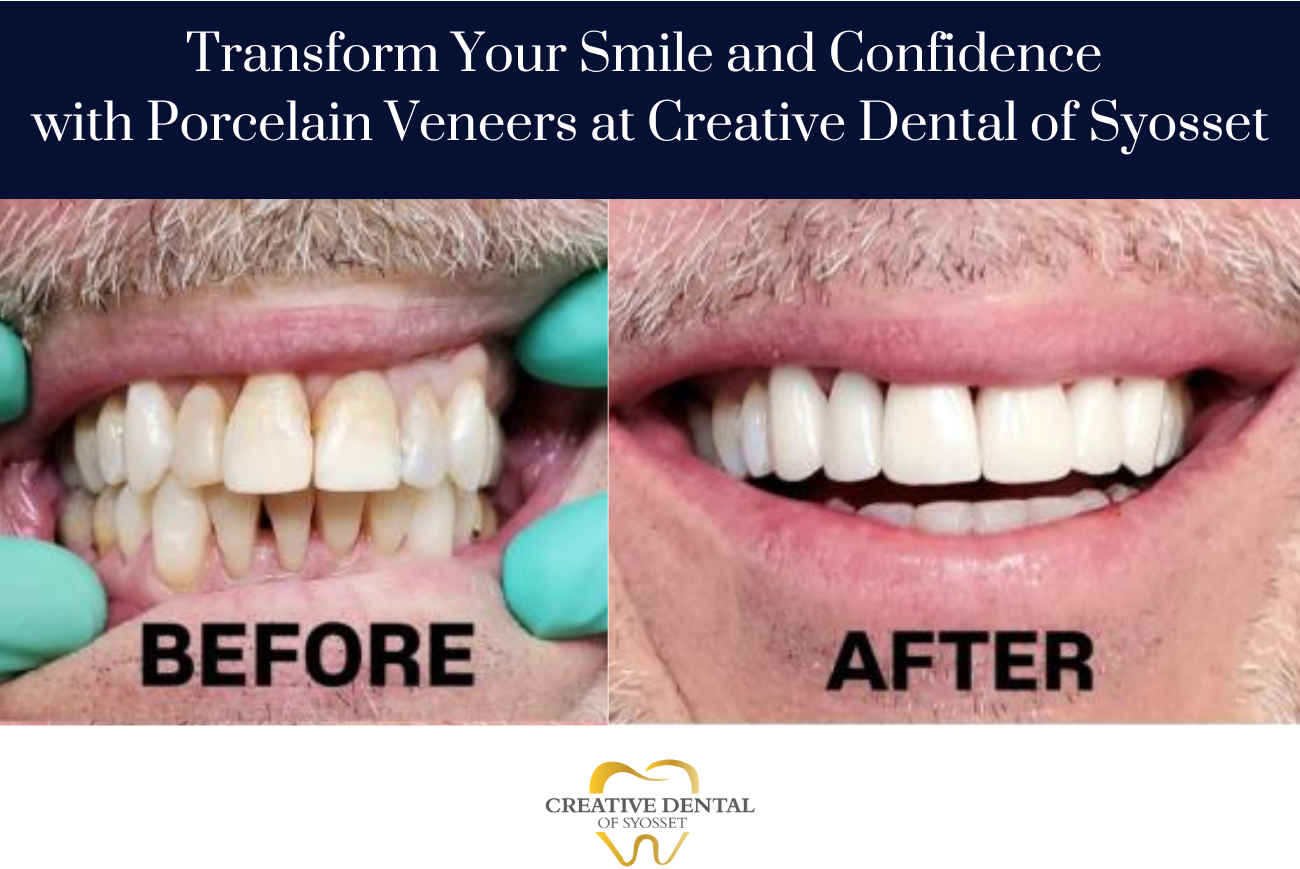 Porcelain Veneers in Syosset, NY: Cost, Procedure, Longevity