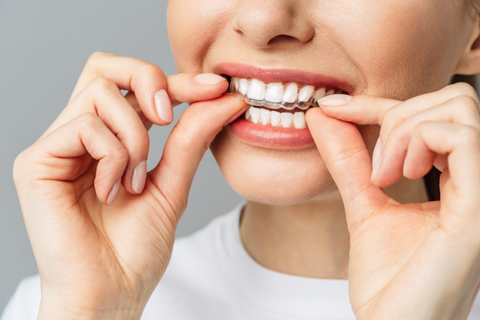 Invisalign in Oyster Bay, NY Creative Dental of Syosset