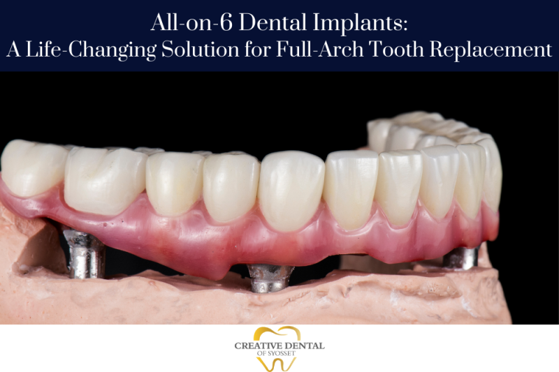 All-on-6 Dental Implants A Life-Changing Solution for Full-Arch Tooth Replacement