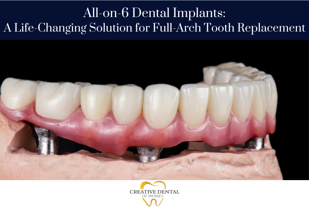 All-on-6 Dental Implants A Life-Changing Solution for Full-Arch Tooth Replacement